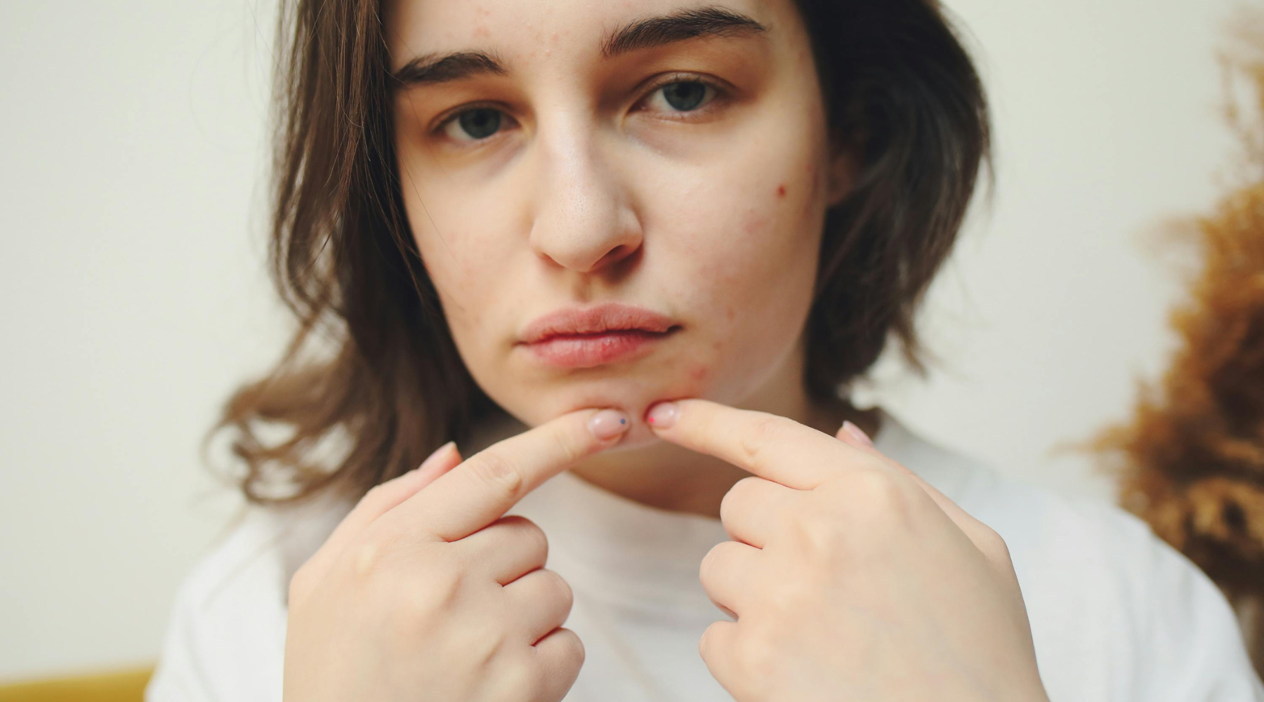 Could Dairy Be Causing Your Acne (and Other Skin Issues)?